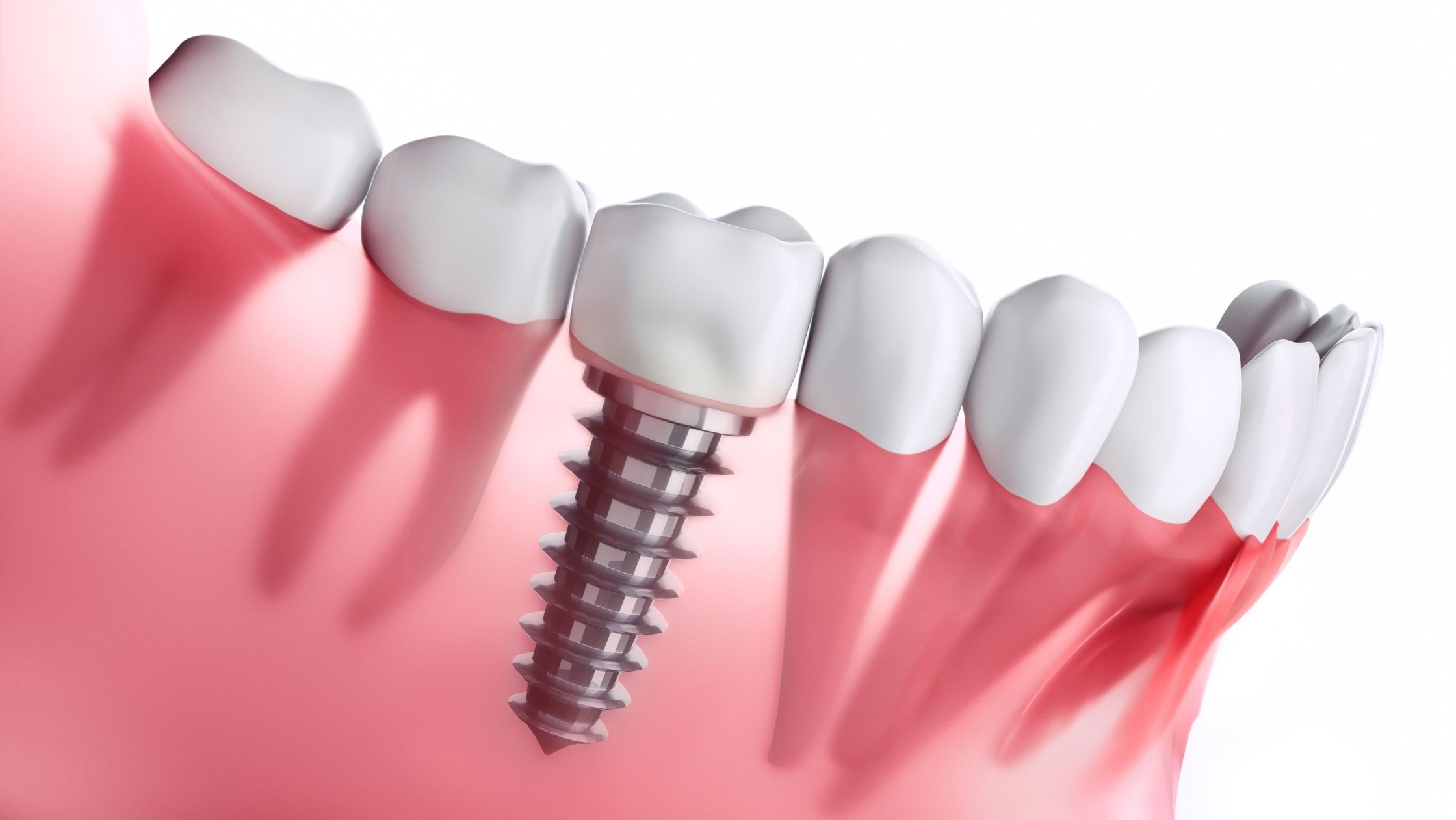 Dental Implants at Nesdent Dental Clinic Istanbul